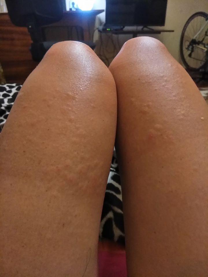 На українському курорті на туристів нападають морські блохи: ось як вони моторошно кусають