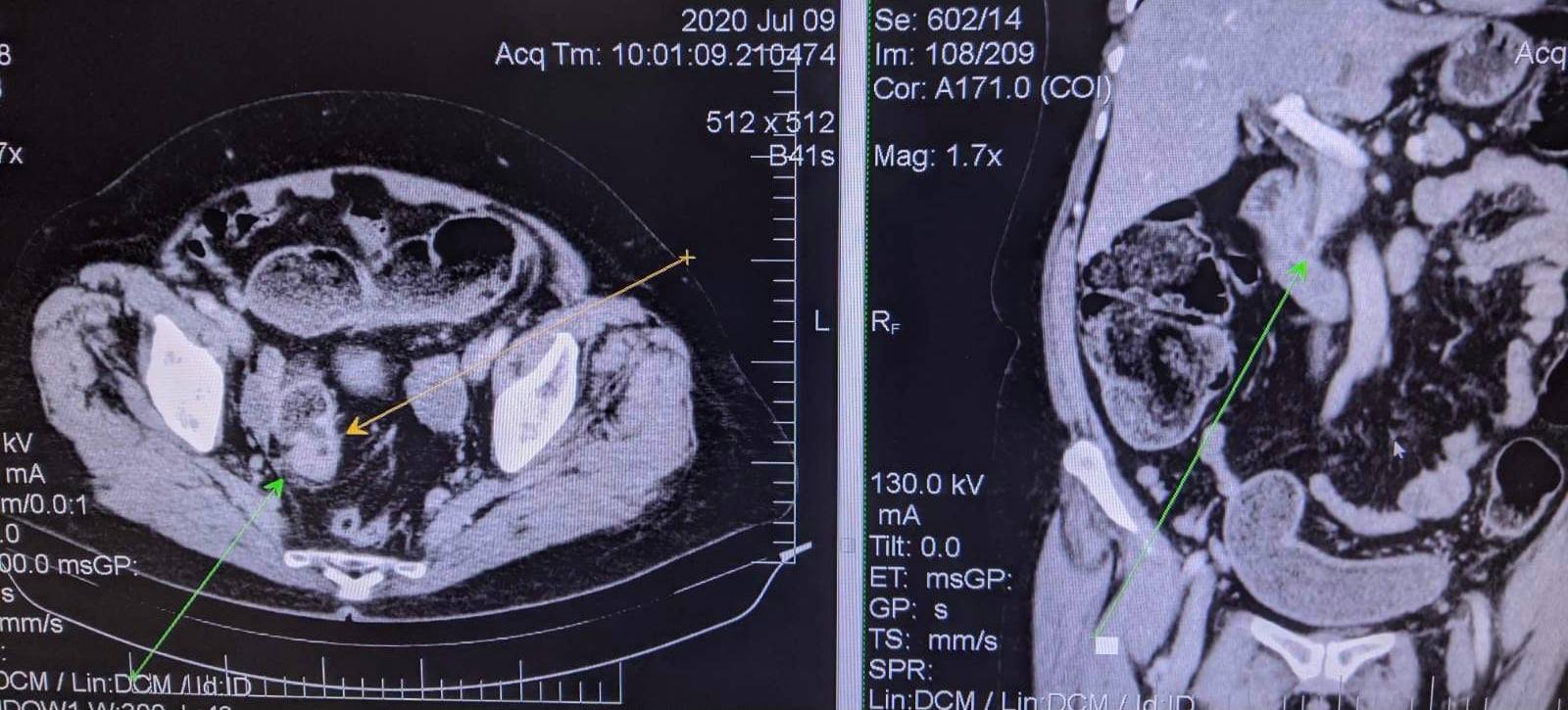 Украинские врачи спасли женщину с необычным диагнозом: таких случаев единицы