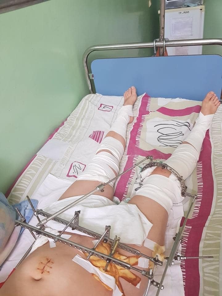 Девушка выпала из окна 4 этажа: нужна помощь