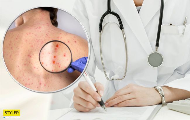 Может пострадать мозг ребенка: врач рассказал об ужасных последствий ветрянки