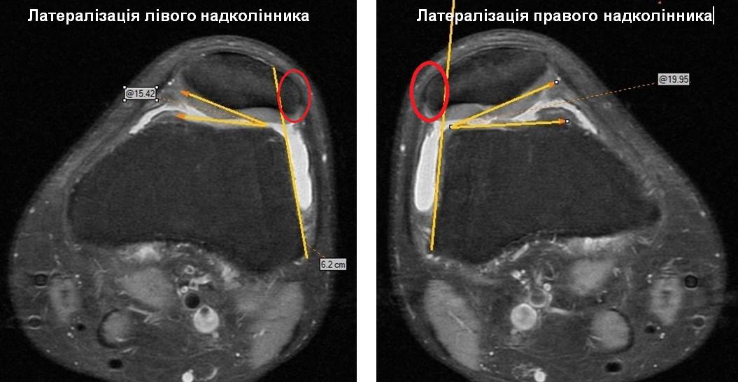 "Пройшов пекло війни і полон в Донецьку": волонтери просять кошти на лікування героя АТО