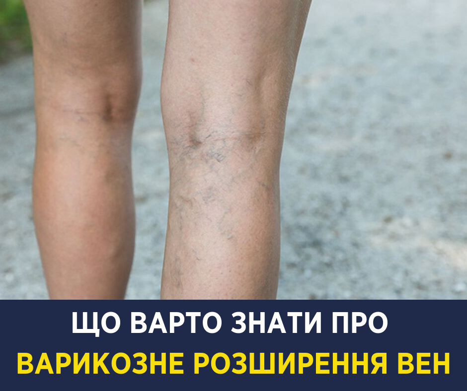 Пытаются лечить кремами: Супрун рассказала о борьбе с варикозным расширением вен