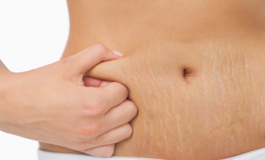 Как избавиться от растяжек и предотвратить их появление