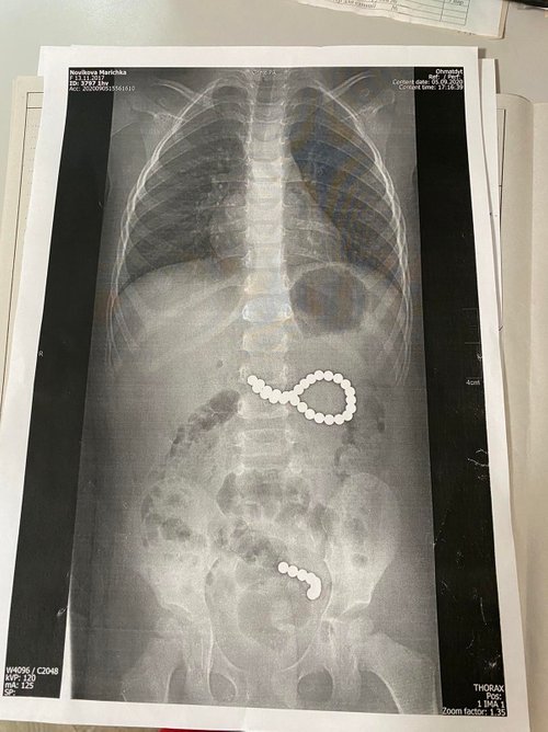 У Львові дівчина проковтнула 36 магнітних кульок: дитині зробили неймовірну операцію