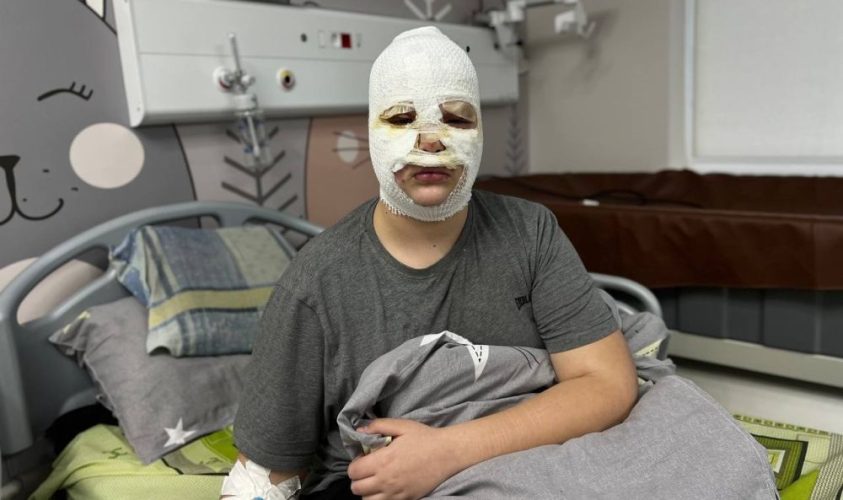 Небезпечний тренд із TikTok. У Львові троє дітей отримали глибокі опіки обличчя