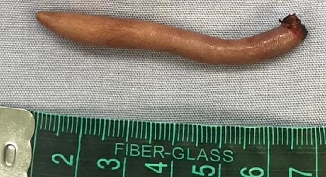 В Мексике родилась уникальная девочка: врачи обнаружили у нее хвост