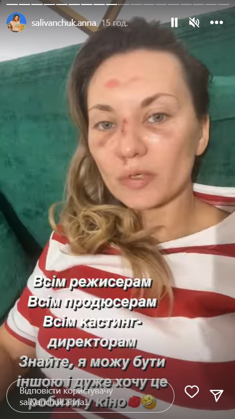 Зірка "Квартала 95" Саліванчук жахнула фото після перелому носа і струсу мозку