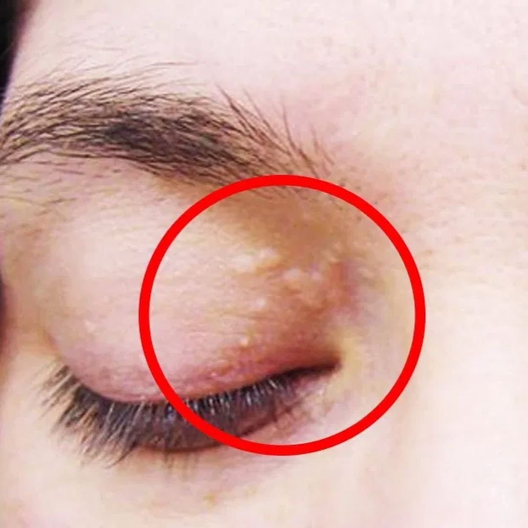 Як по очах розпізнати підвищений рівень холестерину і хто у групі ризику