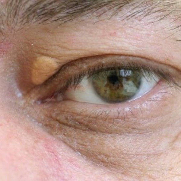 Як по очах розпізнати підвищений рівень холестерину і хто у групі ризику