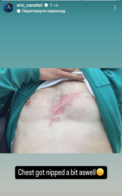 Попал под вышку. Украинский теннисист получил необычную травму перед матчем: видео