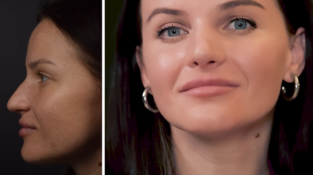 Сколько стоит ринопластика и уменьшение груди: Алина Доротюк назвала сумму