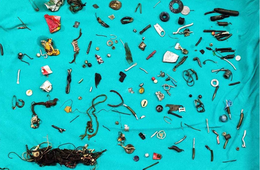 Чоловік потрапив до лікарні з болем у животі: лікарі витягли з його шлунка 60 предметів (фото)