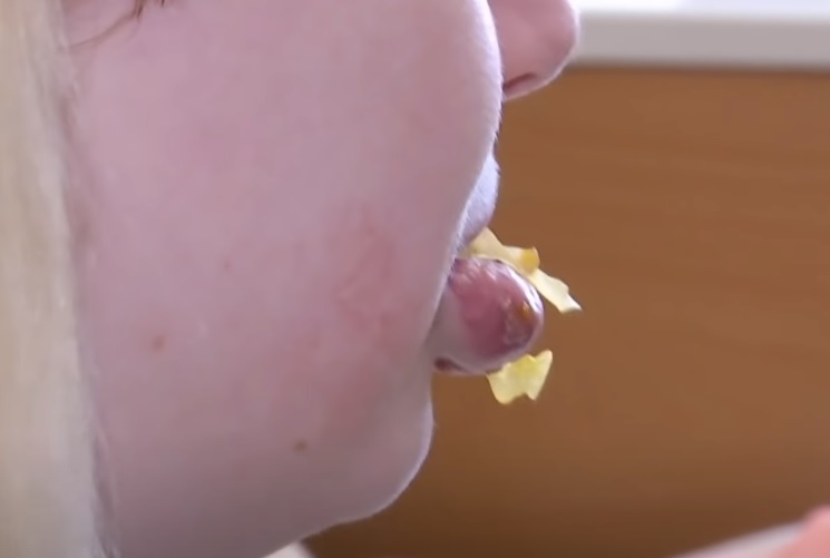 Хотела увеличить губы: в Днепре 14-летняя школьница уколола себе масло и чуть не лишилась части лица