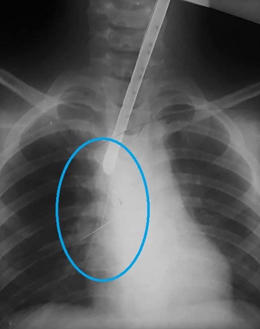 В Днепре ребенок проглотил булавку: врачи спасли необычным способом (фото)