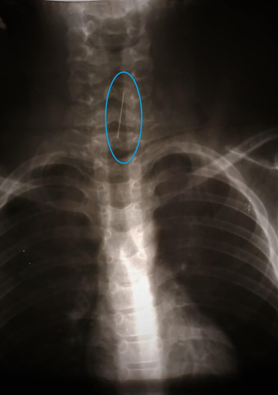 В Днепре ребенок проглотил булавку: врачи спасли необычным способом (фото)