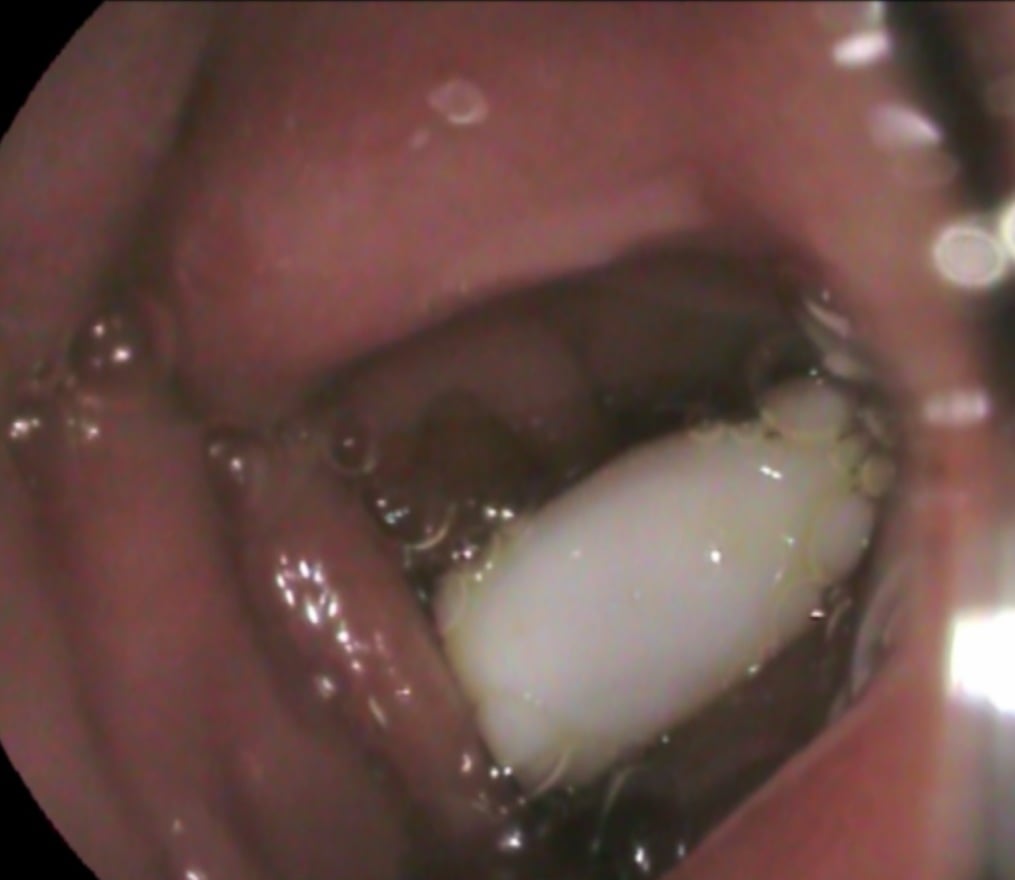 Во Львове парень проглотил распылитель от спрея: как спасали ребенка