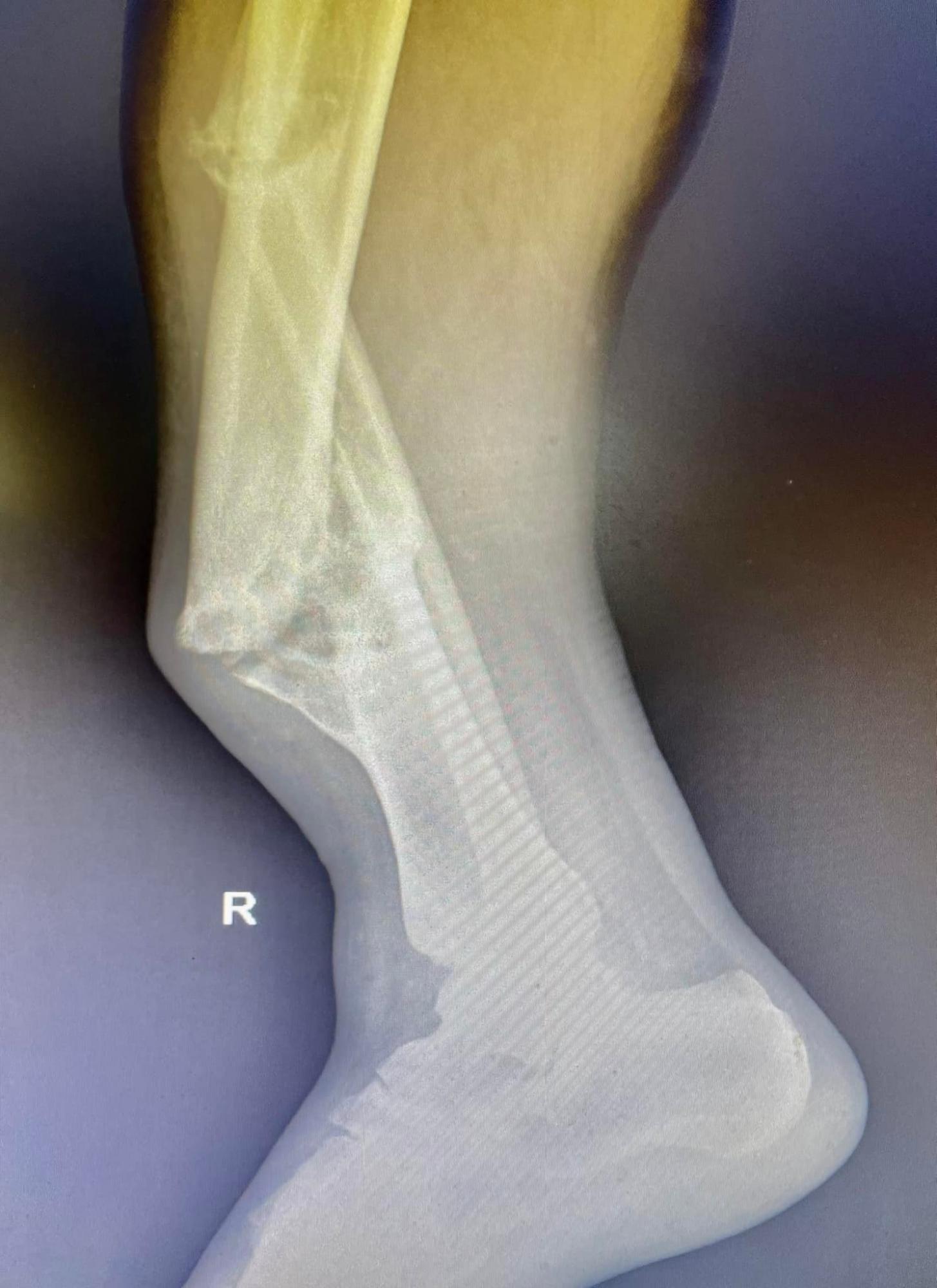 Львовские врачи прооперировали пациента из Славянска, у которого нога сгибалась в разные стороны