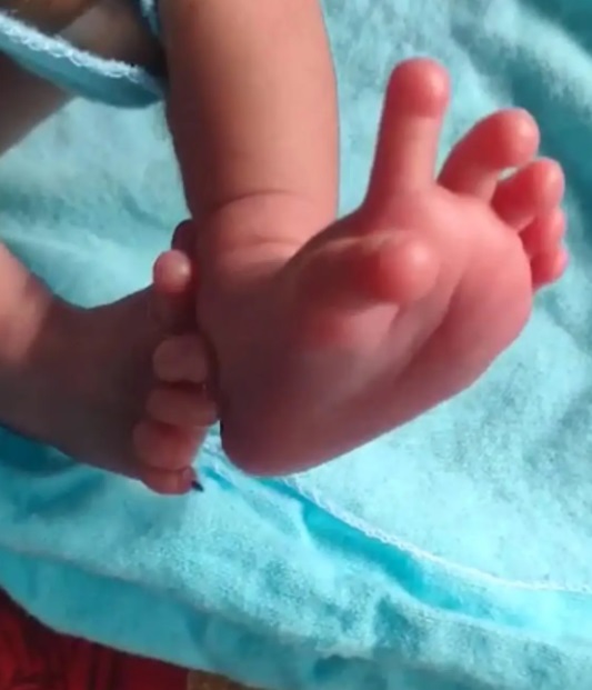 Дівчинка народилася на світ із 26 пальцями: батьки вважають це божественним (фото)
