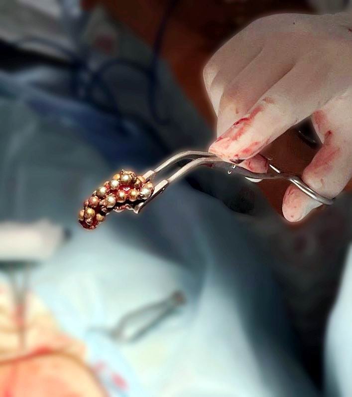 На Волыни двое детей попали на хирургический стол из-за игрушки, оказавшейся в мочевом пузыре