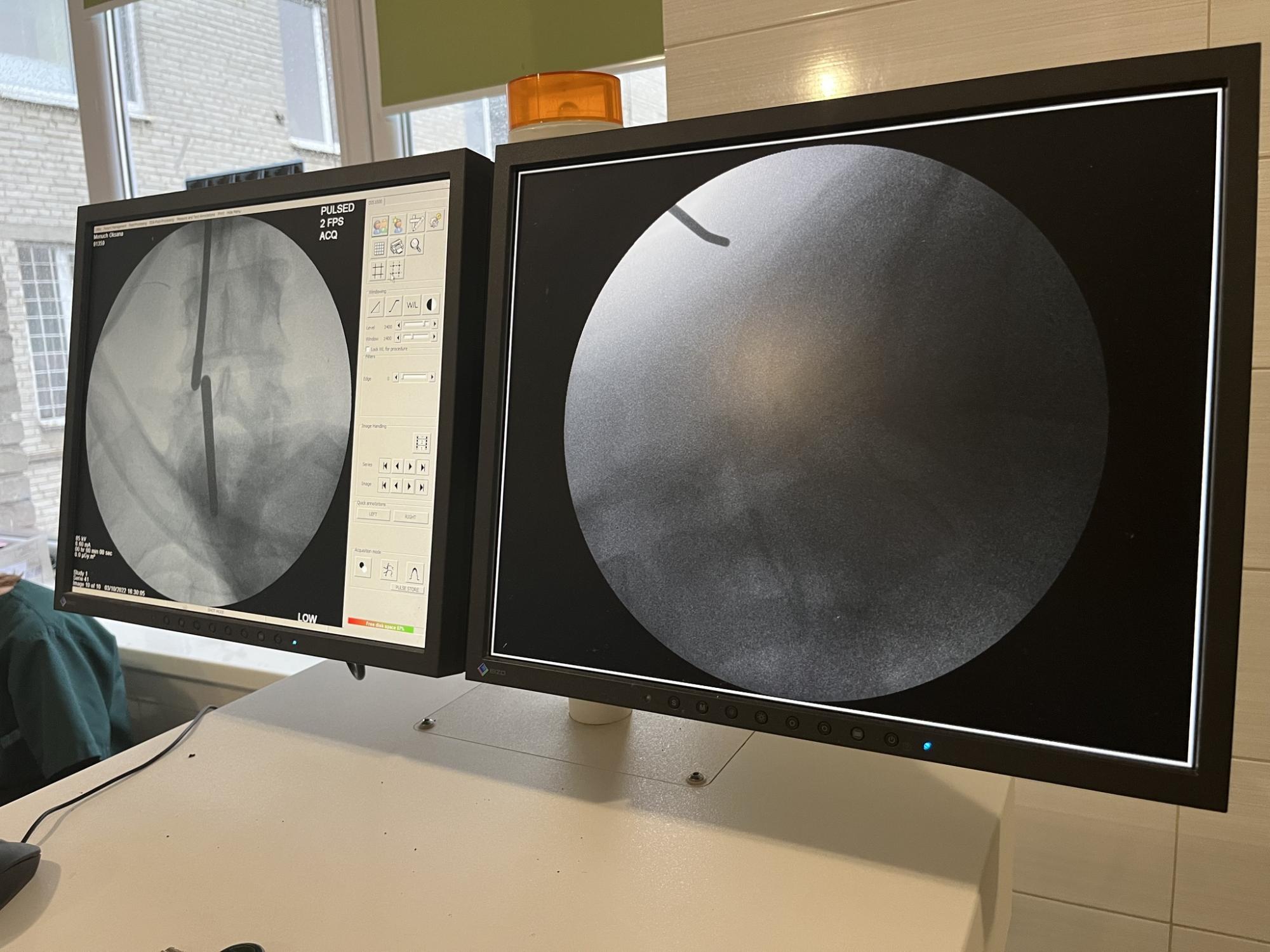 Через кілька годин пацієнтка вже ходила: у Львові лікарі провели унікальну операцію  на хребті