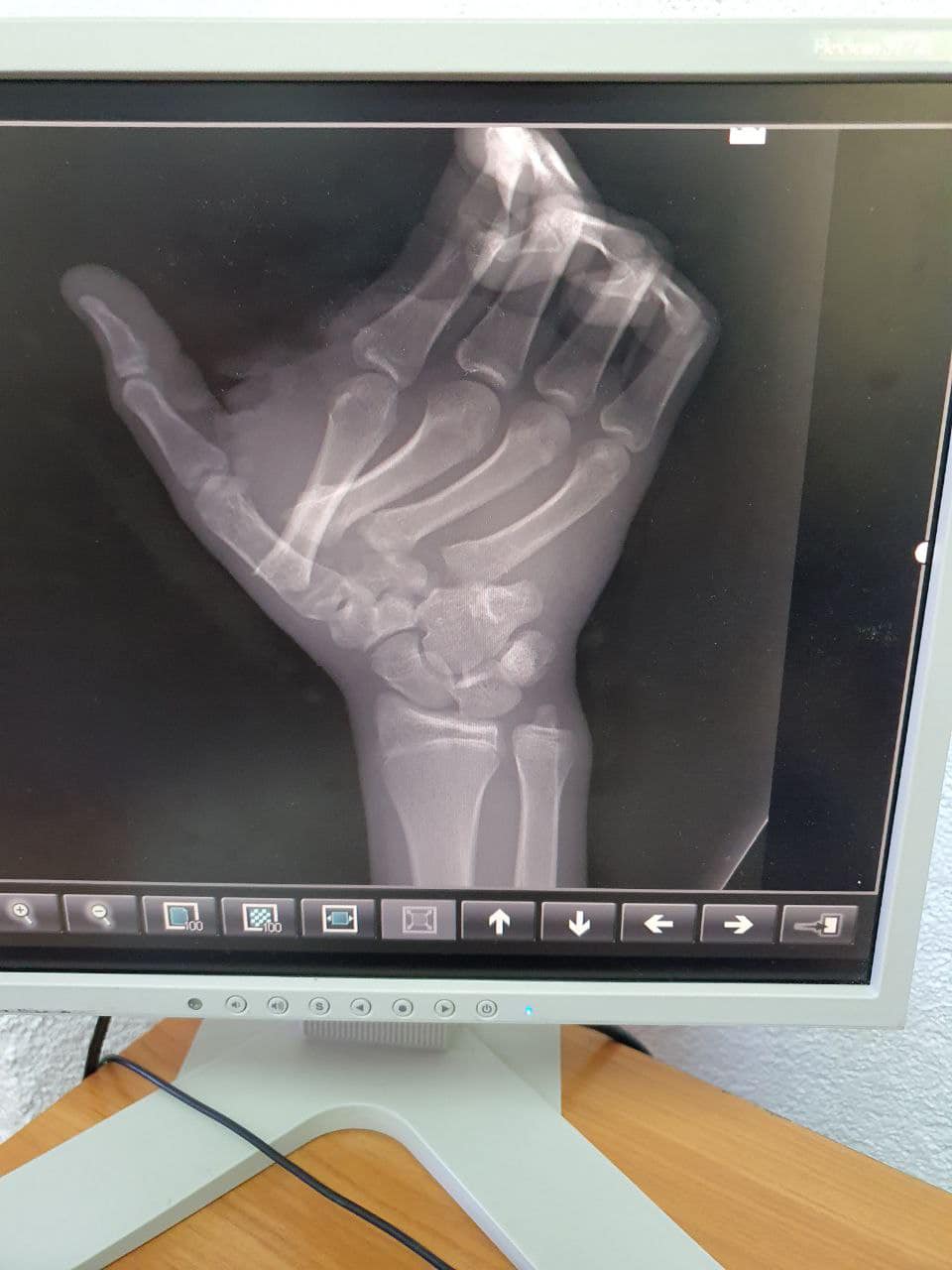 Вперше працювали з такою складною травмою: у Львові лікарі дивом врятували хлопцю руку