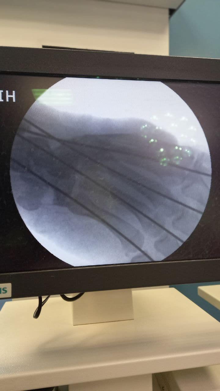 Вперше працювали з такою складною травмою: у Львові лікарі дивом врятували хлопцю руку