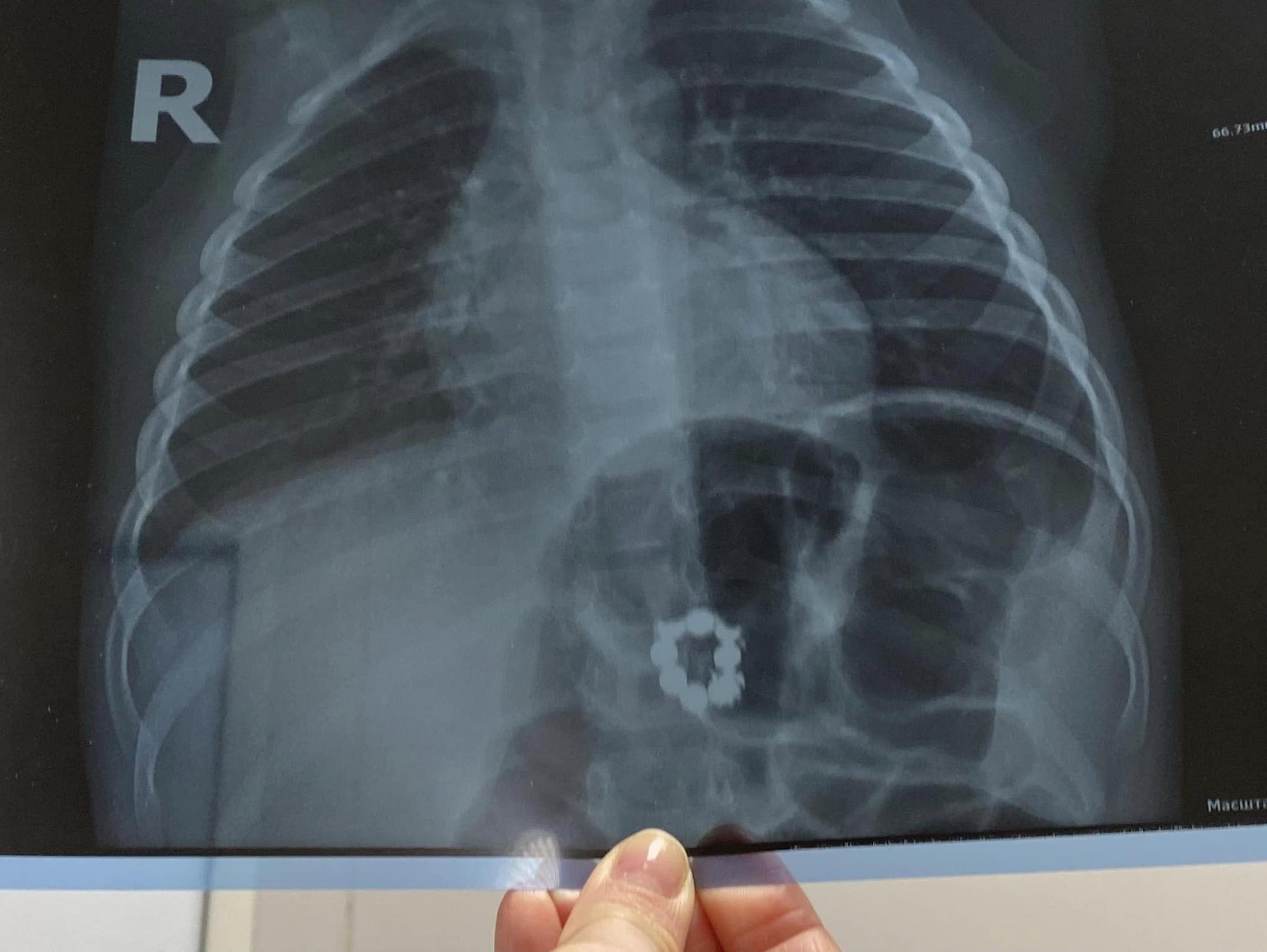 В Киеве 3-летний мальчик проглотил магниты и месяц жил с ними: родители не догадывались