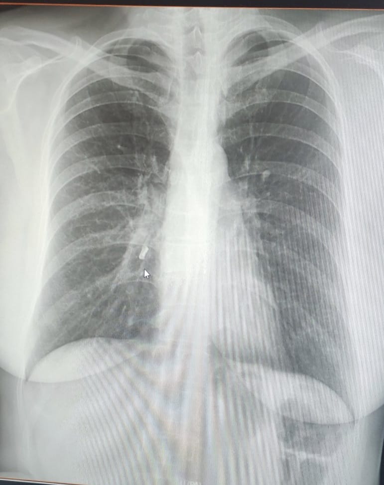 Прожила із зубом у бронхах понад півроку: лікарям у Львові вдалося врятувати жінку