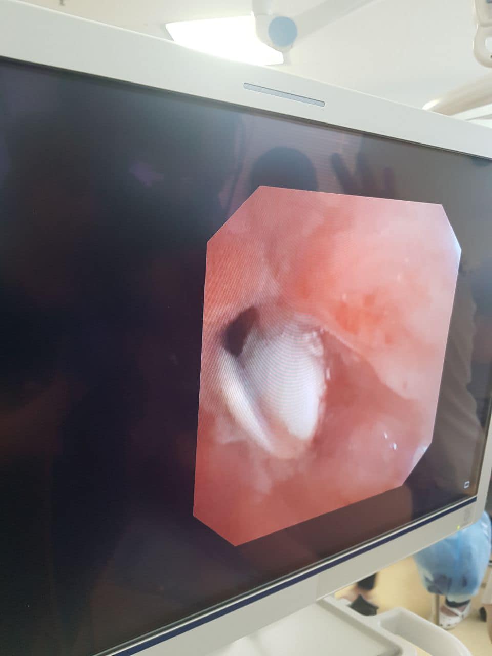 В Україні в організмі дитини виявили ложку, яка знаходилась там кілька місяців (фото)