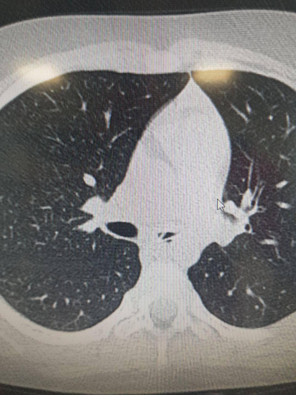 В Україні в організмі дитини виявили ложку, яка знаходилась там кілька місяців (фото)