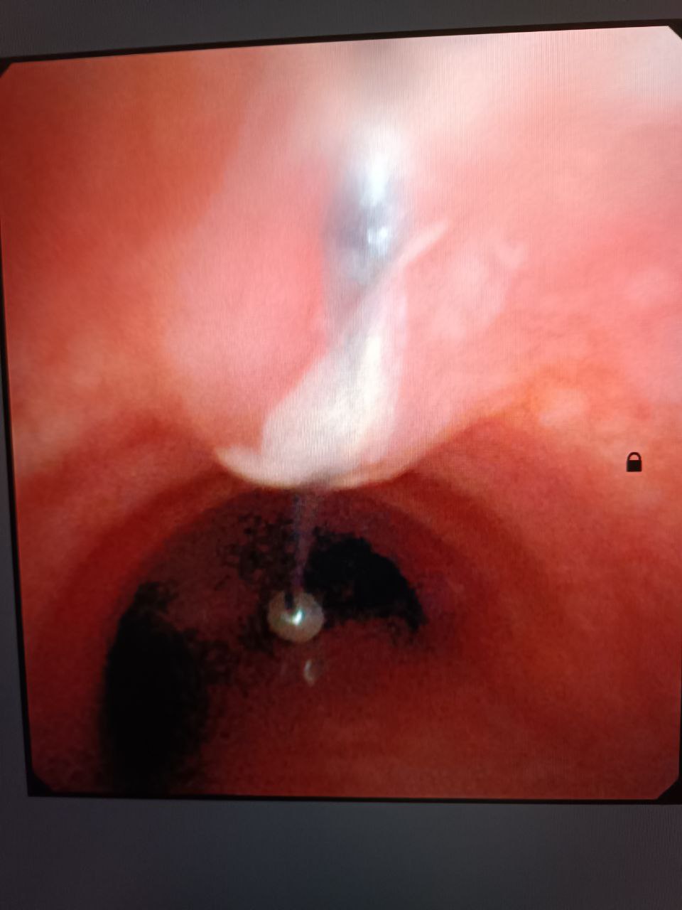 Застрягла прямо у трахеї: в Одеській області підліток випадково вдихнув шпильку