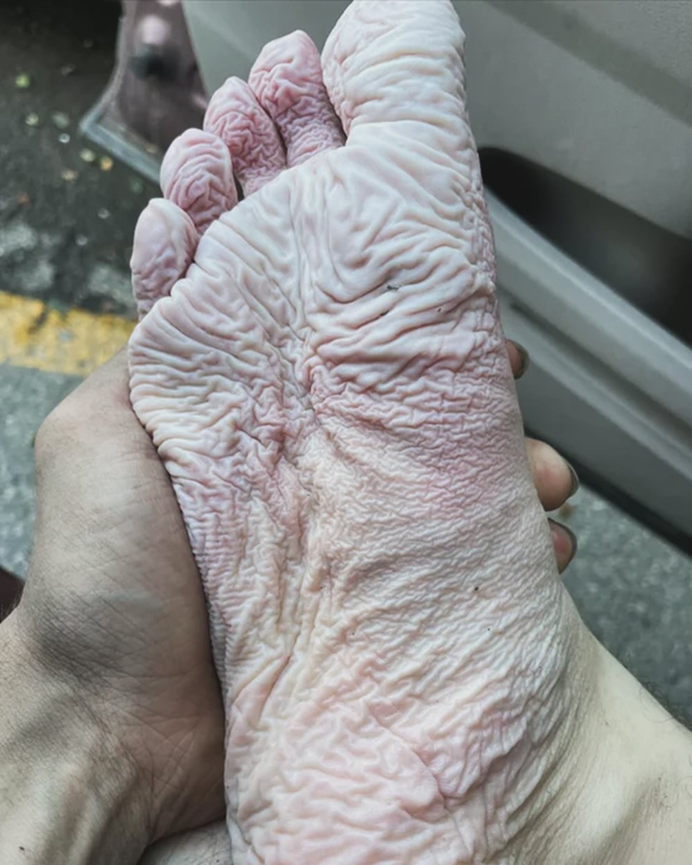 Часта проблема на війні: дерматолог розповіла, чому виникає "окопна стопа"