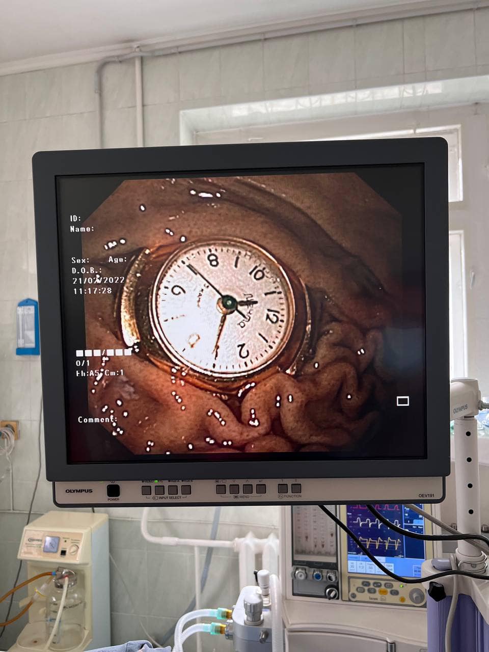 В Киеве врачи спасли 3-летнего мальчика, который проглотил часы (фото)