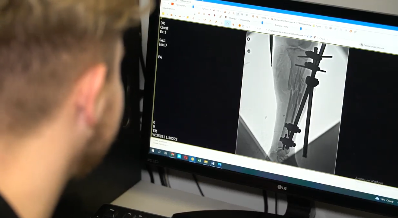 "Рідним сказали, що я загинула": у Львові врятували життя жінці з Бахмута