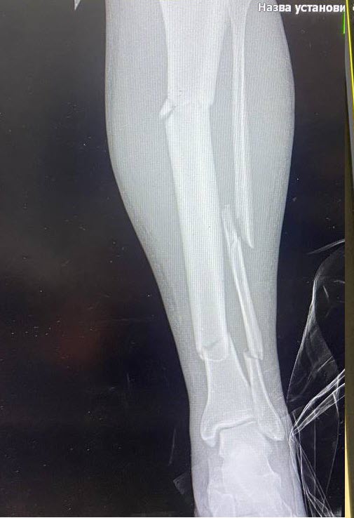 "Всі, хто був поряд, полягли". Медики розчулили історією порятунку воїна