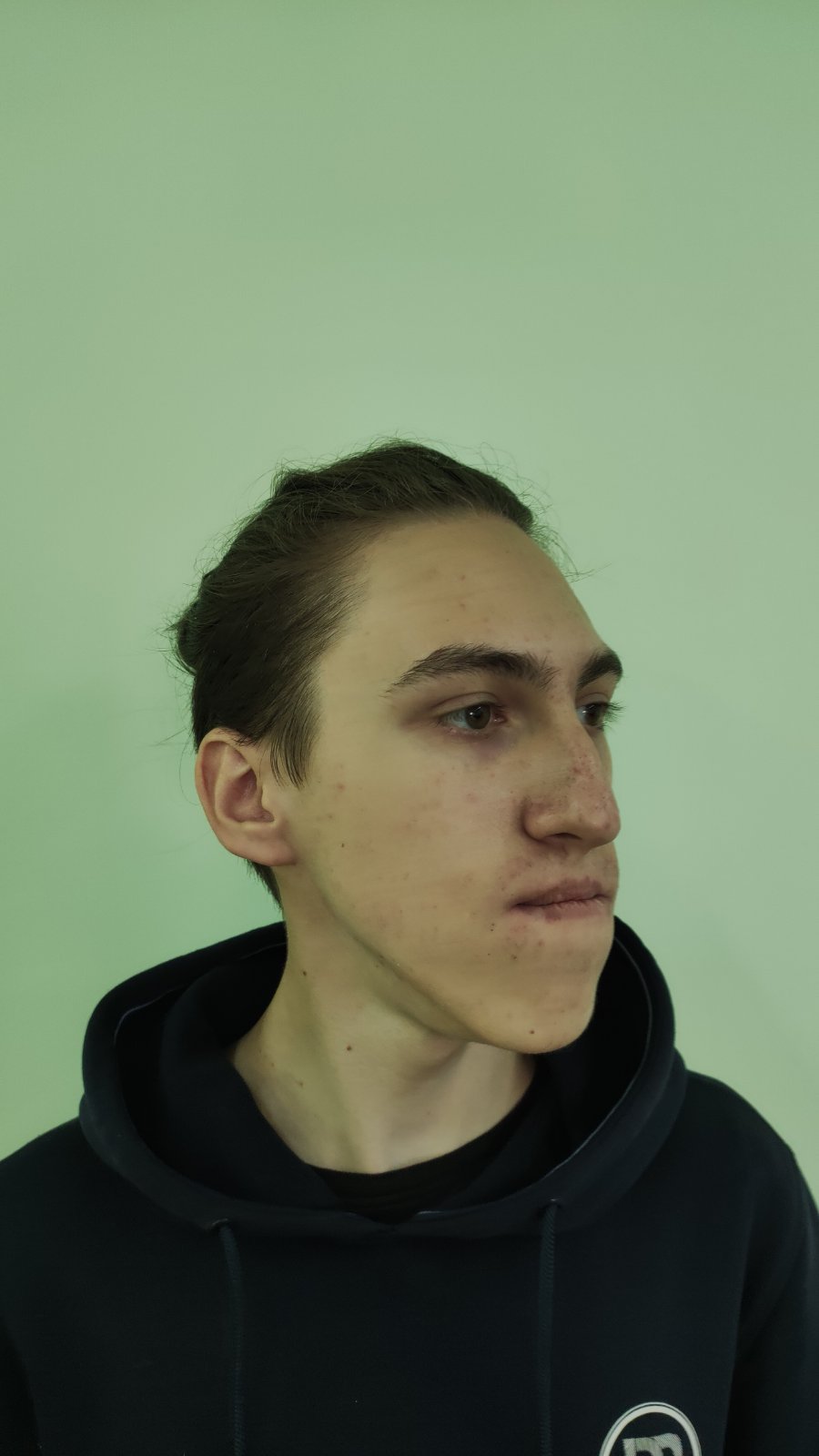 "Склали, як кубики лего": у Львові реконструювали обличчя хлопцю з важкою вадою