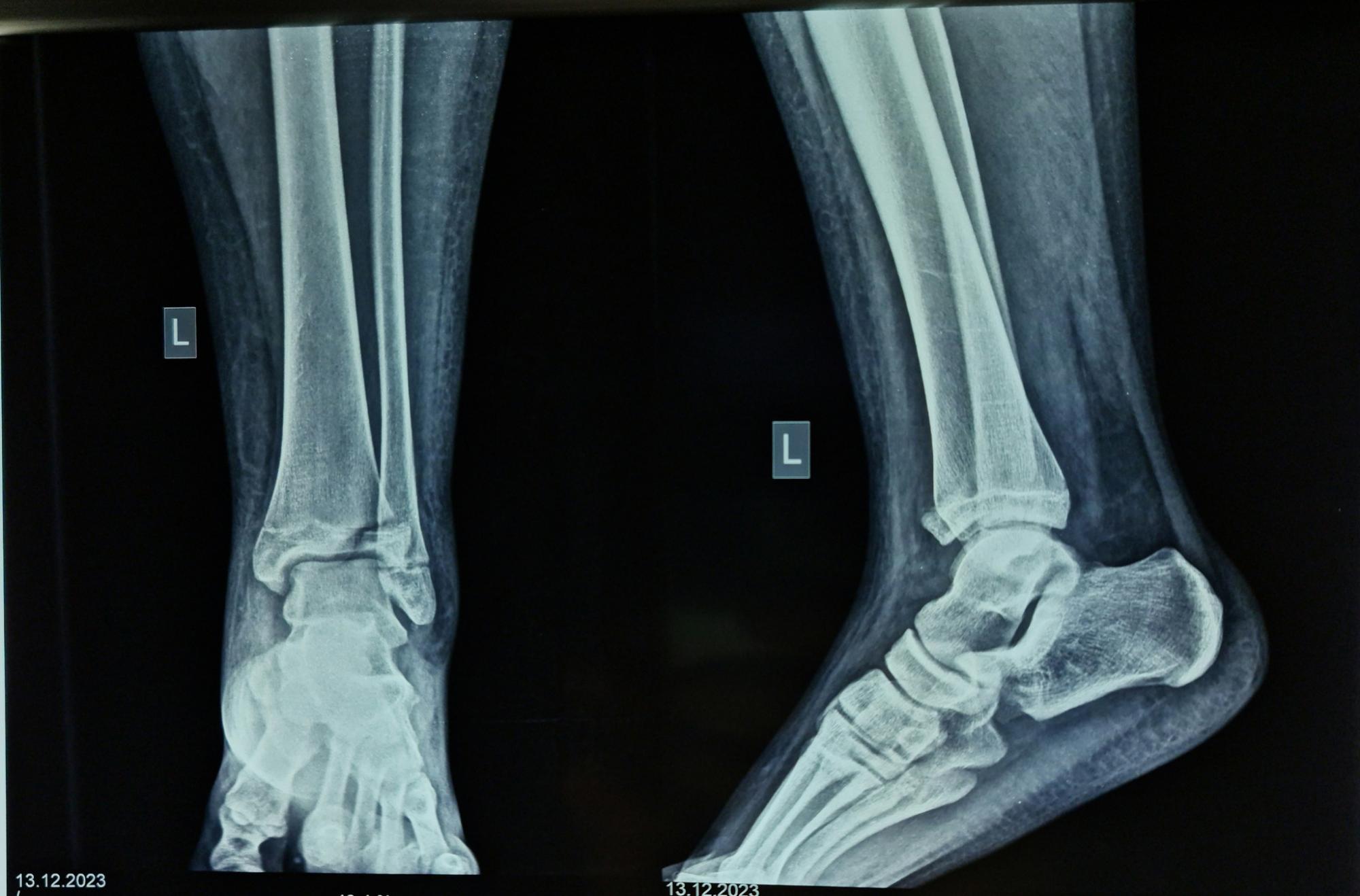 Не зверталась до медиків два тижні: у Рівному в дівчини виявили рідкісний перелом (фото)