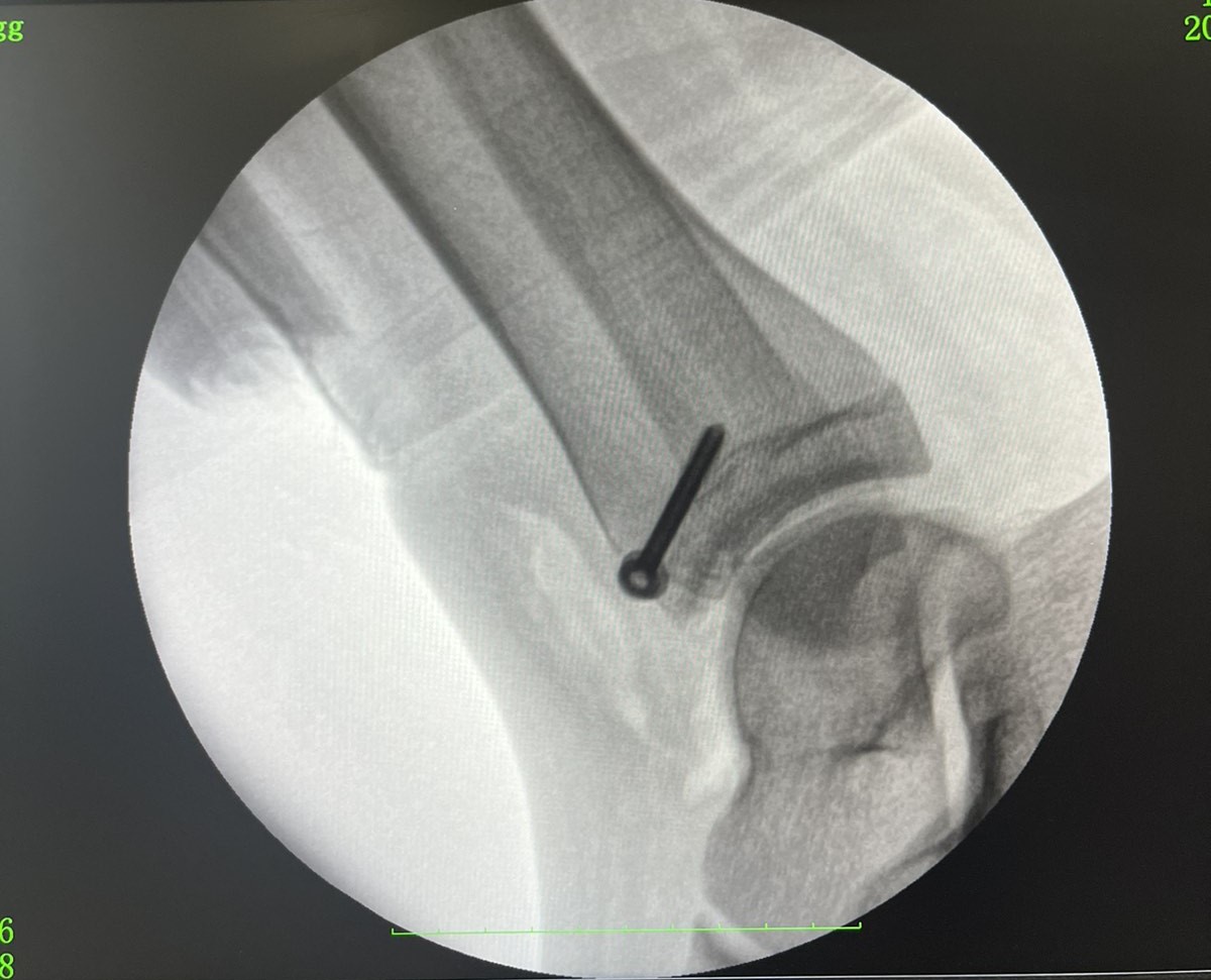 Не зверталась до медиків два тижні: у Рівному в дівчини виявили рідкісний перелом (фото)