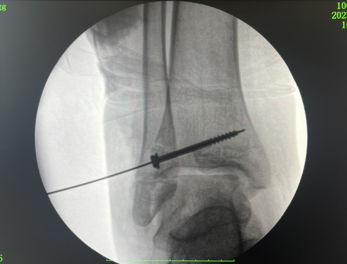 Не зверталась до медиків два тижні: у Рівному в дівчини виявили рідкісний перелом (фото)