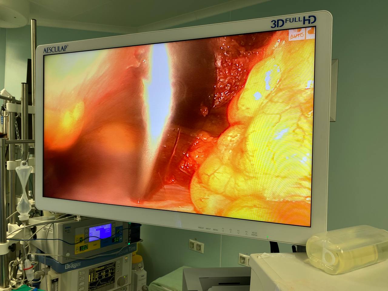 Могла в будь-який момент померти: у Києві в жінки виявили 12-сантиметрову кісту біля серця