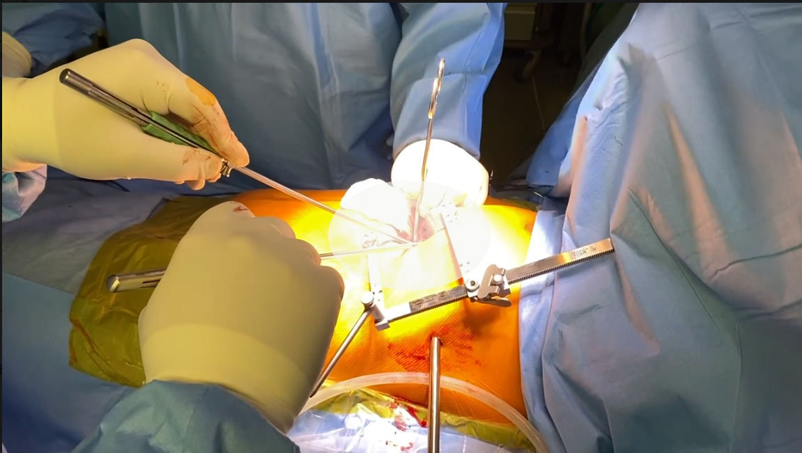 Могла в будь-який момент померти: у Києві в жінки виявили 12-сантиметрову кісту біля серця