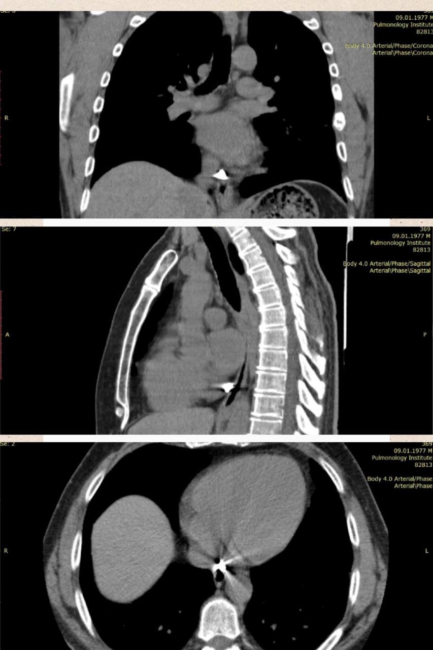 Уламок застряг прямо в серці: у Києві врятували воїна за допомогою магніту (фото)