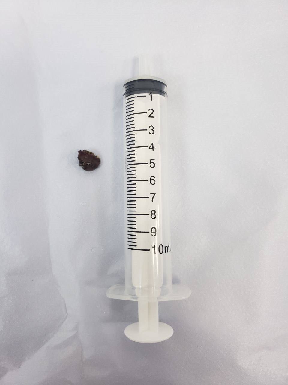 Уламок застряг прямо в серці: у Києві врятували воїна за допомогою магніту (фото)