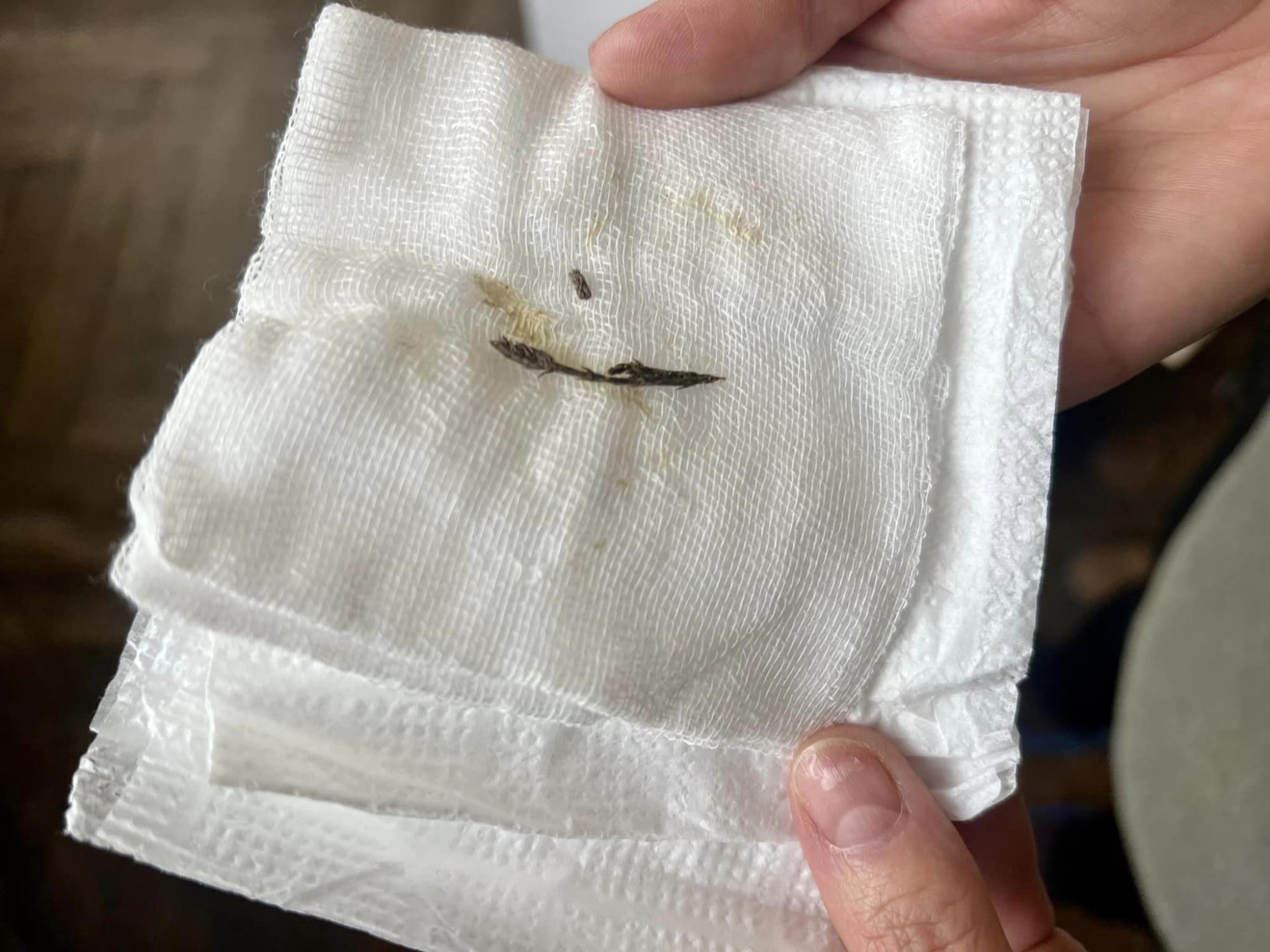 Півтора року не могли поставити діагноз: у Львові у бронхах хлопчика знайшли хвойну гілочку