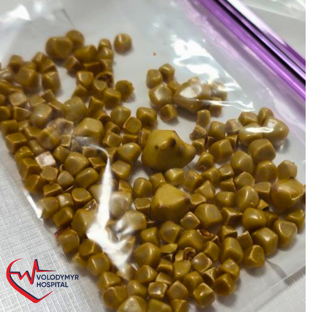 Удалили более 100 камешков: на Волыни спасли жизнь женщине