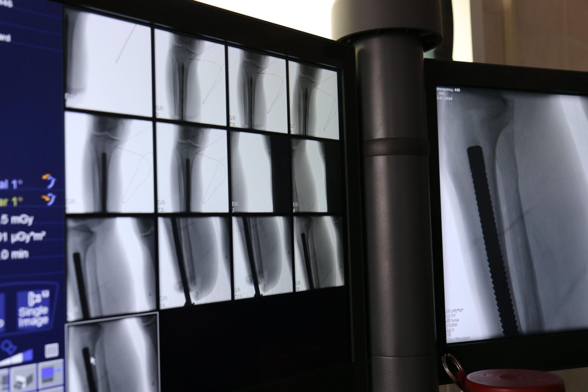 Ця методика інноваційна для України. У Вінниці провели унікальну операцію з протезування