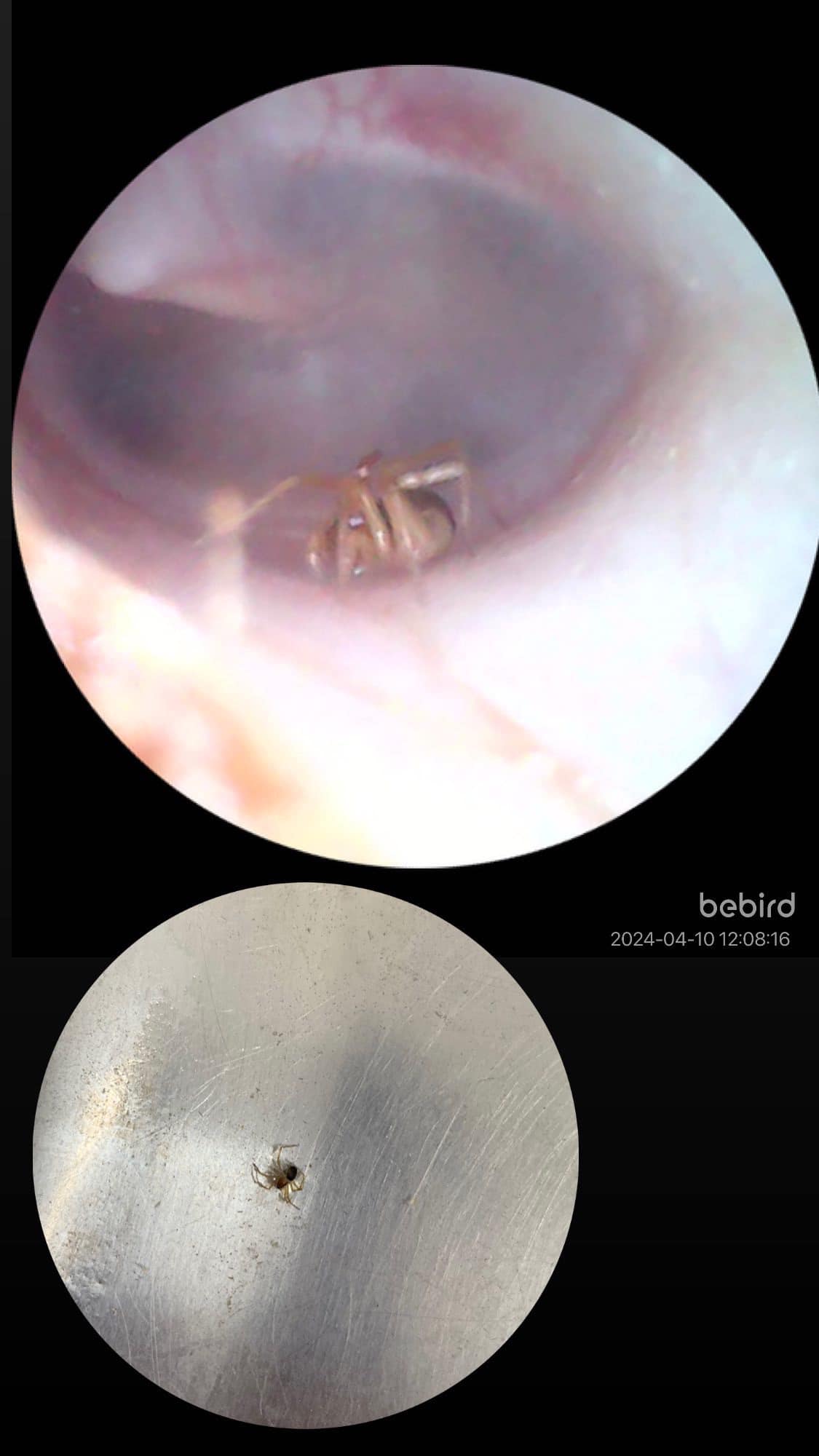 "Цікава знахідка": під Тернополем у вусі 4-річного хлопчика виявили павука
