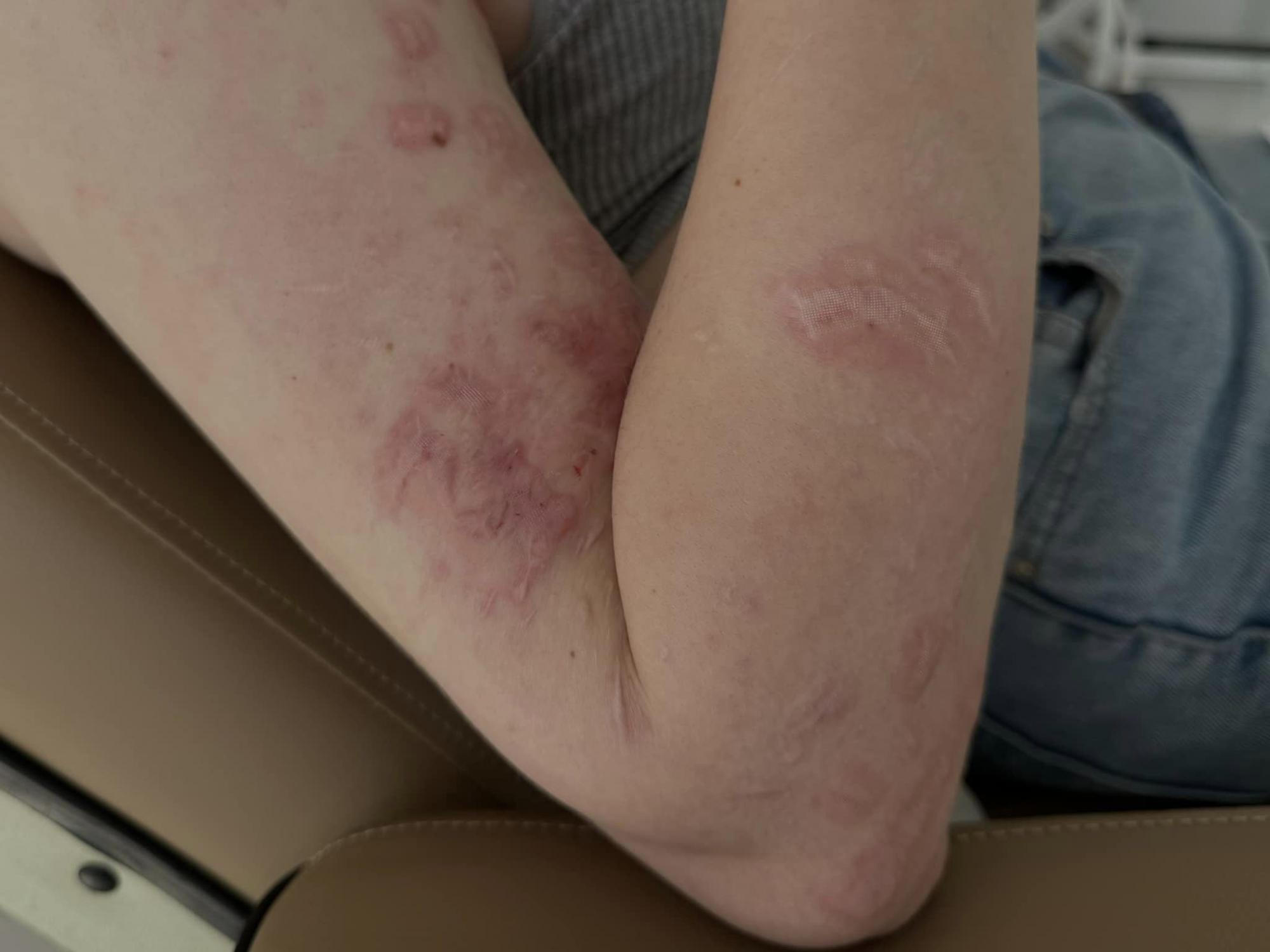 Ракета изувечила лицо: медики "возвращают красоту" 20-летней девушке перед свадьбой