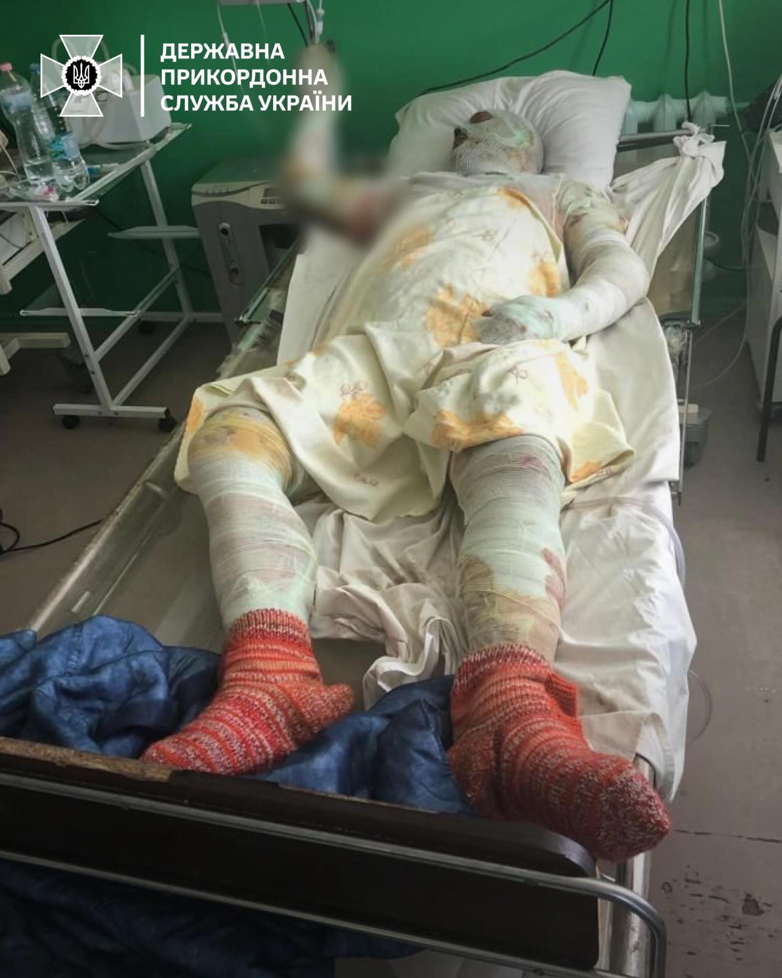 "Перемогти заради сина". Прикордонник з 70% опіків шкіри повернувся на службу