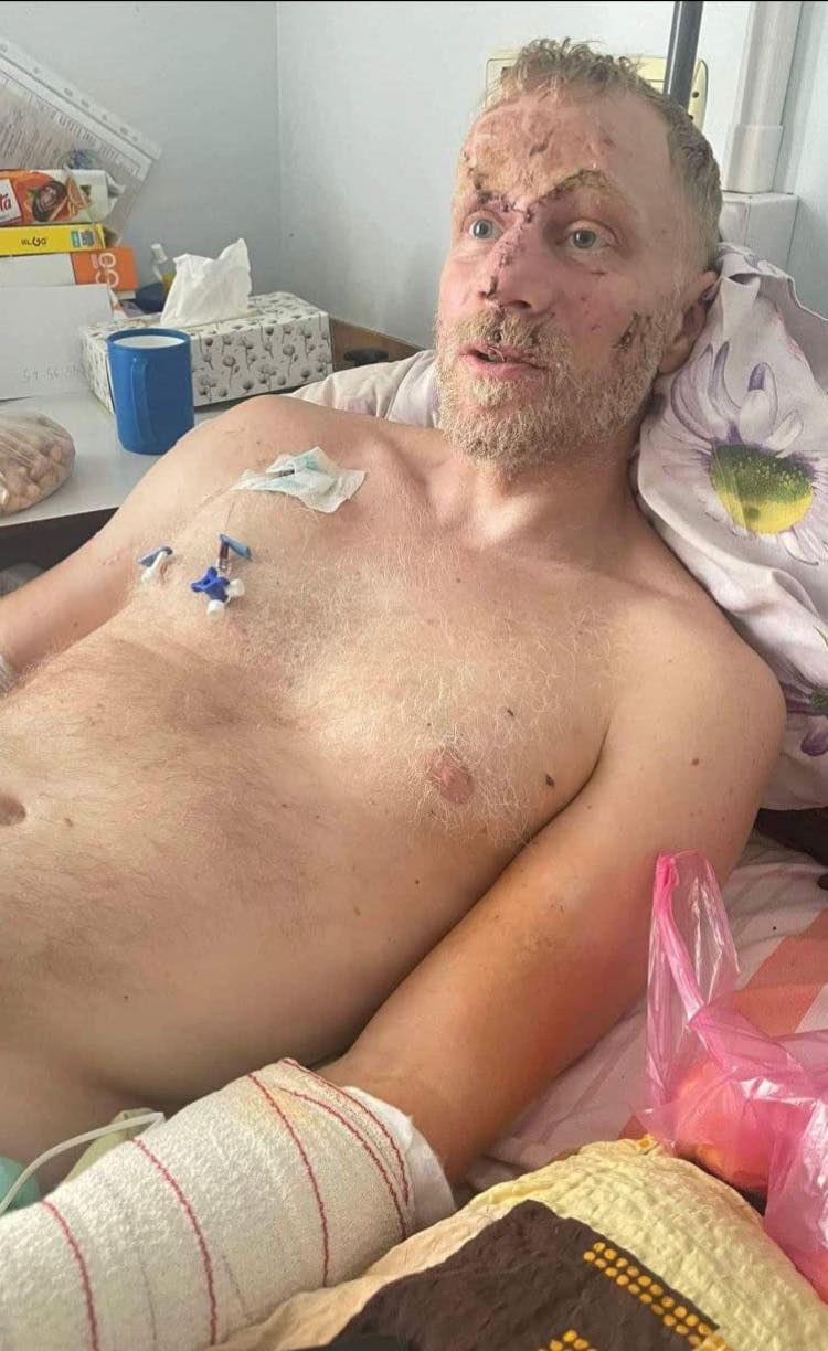 Уламки, контузії та важкі травми: українські зірки, які отримали поранення на фронті